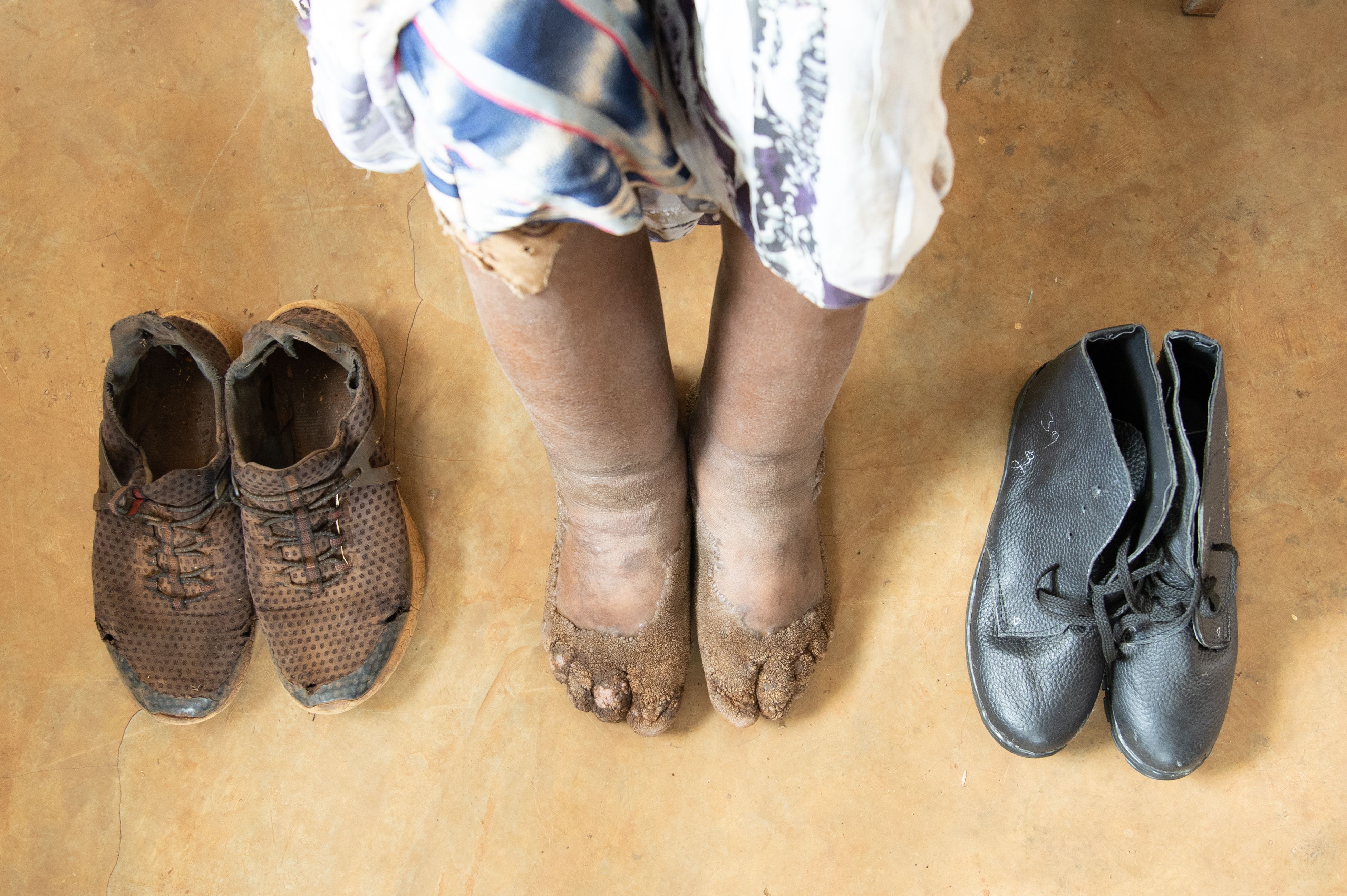Feet of person with podoconiosis with two pairs of boots either side