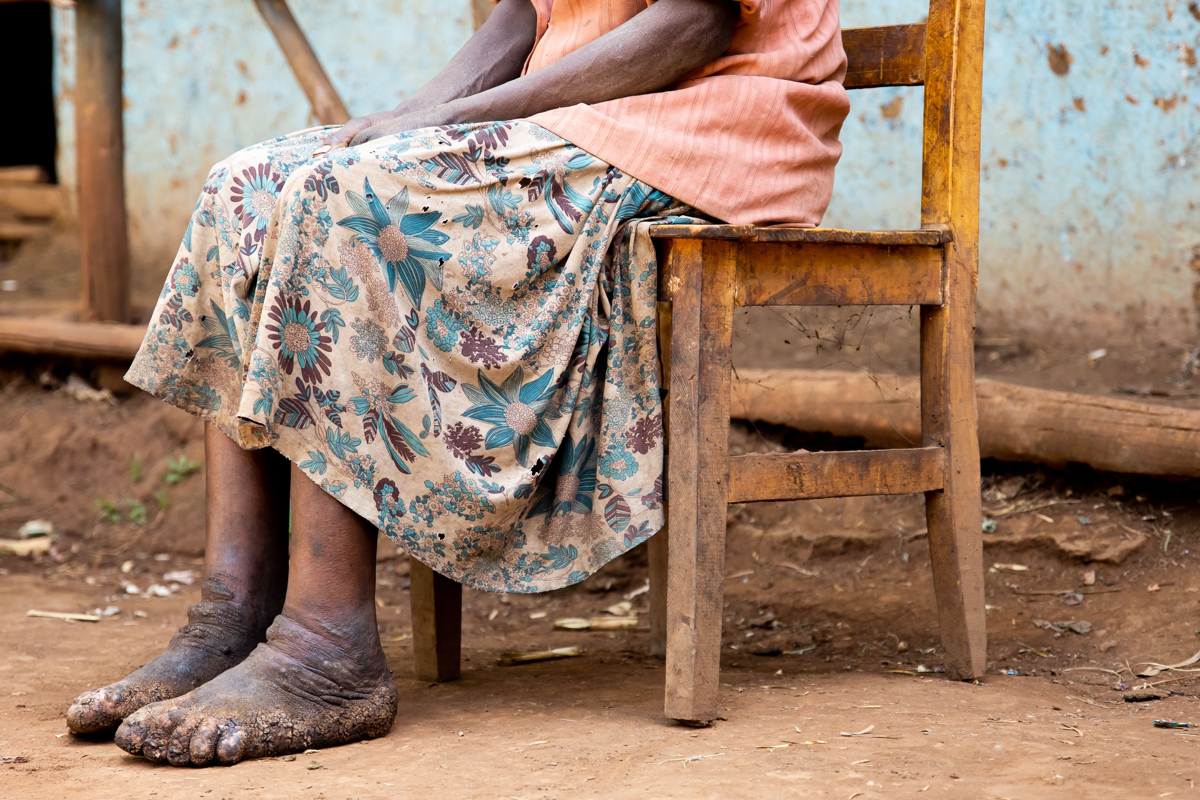 Woman barefoot with podoconiosis