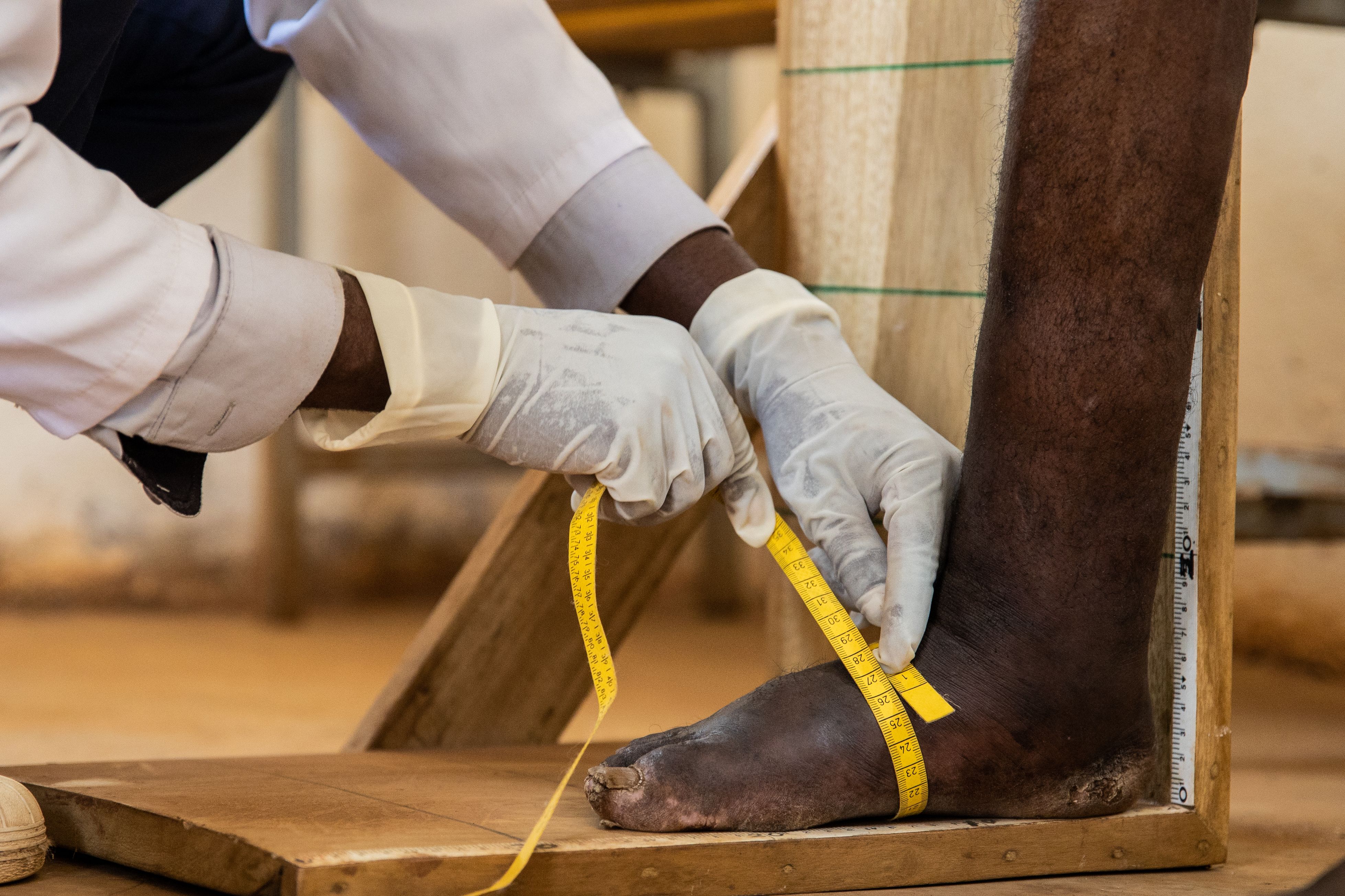 Tape measure held around foot of person with podoconiosis